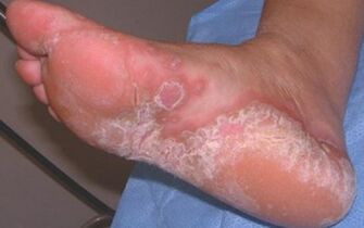 Dermatomicose aguda do pé