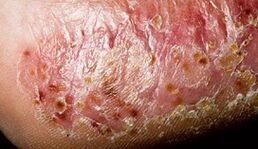 Dermatomicose