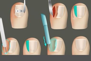 Removendo a unha na presença de um fungo nas pernas