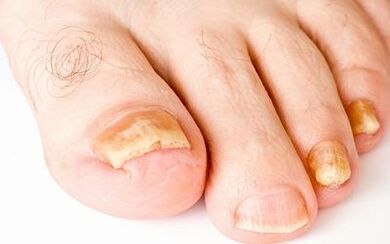 Sintomas fotográficos de fungo das unhas