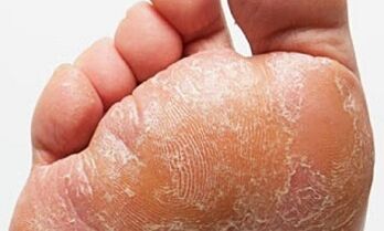 Sinais e sintomas de fungo nas pernas